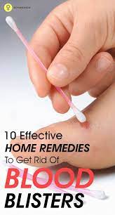 They tend to take the appearance of pimple with blood and other fluid trapped inside. Shannen Heyman Shannenheyman Profile Pinterest