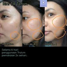 Jual Trulum Skincare Di Mapat Tunggul Pasaman Wa 0811 233 8376 Trulum Merupakan Produk Skincare Perawatan Wajah Terlaris Abad Ini Ya Toner Obat Jerawat Serum