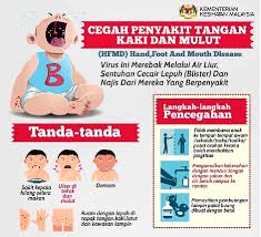 Ia biasanya bermula dengan demam dan rasa tidak sihat. Pengalaman Penjagaan Anak Kecil Yang Dijangkiti Hfmd Dr Jamu