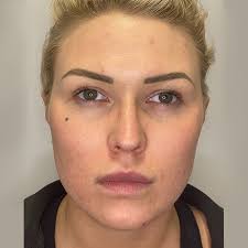 Clear Skin with AC Dual IPL Acne Treatment: Olive Tree Aesthetics