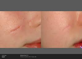 Skin Renewal Houston Scar Removal Bellaire