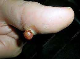 Image result for Pyogenic Granuloma