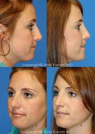 Rhinoplasty Before And After Patient Photos Rhinoplasty Nose Job Rhinoplasty Before And After