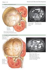 Simple Cysts Renal Cysts Sometimes Occur As Part Of An Inherited Disease Such As Polycystic Kidney Di Polycystic Kidney Disease Cysts Polycystic Kidneys