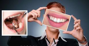 Seperti kayu reklamasi, larangan sugi shou memiliki aksen kuno tertentu. Anda Tergolong Dalam Golongan Gigi Kuning Cuba Tips Ni Untuk Dapat Gigi Putih Nona