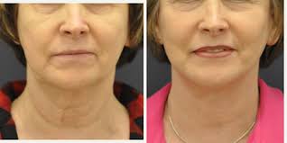 Mark Been, MD, Board Certified Facial Plastic Surgeon