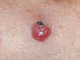 Mccs are dermally based tumors composed of small uniform round blue cells of new american joint committee on cancer staging system for merkel cell carcinoma. Merkel Cell Carcinoma The Skin Cancer Foundation