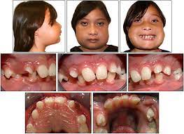 Cherubism is a rare genetic disorder that causes prominence in the lower portion in the face. Orthodontic Management Of A Patient With Cherubism A Case Report American Journal Of Orthodontics And Dentofacial Orthopedics