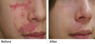 Laser tattoo removal is a process that may take a series of five to. Gentle Aesthetics Med Spa Med Spa Braintree Ma South Shore Boston