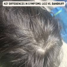 Image result for lice vs dandruff