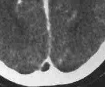 Sinusvenenthrombose als sinusvenenthrombose wird das auftreten von blutgerinnseln in den großen sammelvenen des. Mri Library Sinusvenenthrombose