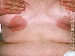 Image result for sore skin in the groin area