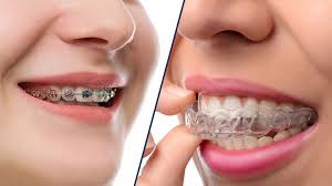 From gaps to overbites, to teeth or jaw alignment there are many factors that can affect while the time it takes for braces to do their thing varies greatly by patient, after an initial evaluation and consultation, dr. What Are The Alternatives To Braces For Straightening My Teeth North Sydney Dental Practice