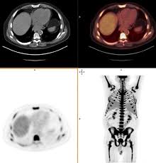 Support and protect internal organs. Bone Marrow Radiology Reference Article Radiopaedia Org