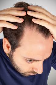 How does keratosis pilaris look like? Hair Loss Alopecia Hair Loss Cherry Hill Camden County Burlington County Marlton Evesham Voorhees Township Delran Moorestown Mount Laurel Township Haddonfield Barrington Cinnaminson Gibbsboro Startford Lindenwold Clementon