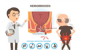 Image result for Hemorrhoid
