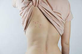 Women of any size, shape, and color are beautiful. Damaged Skin On Female S Back Bedbug Bites Moosquito Bites Or Skin Disease On Human Body Buy This Stock Photo And Explore Similar Images At Adobe Stock Adobe Stock