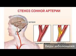 Chto Takoe Stenoz Sonnoj Arterii I Kak Ego Lechit Gbuz Pk Gajnskaya Crb