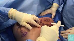 Areola Reduction Procedure Youtube