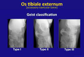 Os Tibiale Externum Geist Classification Radiology Case Radiopaedia Org Classification Skin Disorders Lower Limb