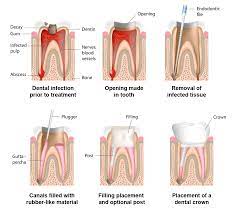 6 ways to detect cavitiesdo i have a cavity? Root Canal San Diego Ca Balboa Dental Care