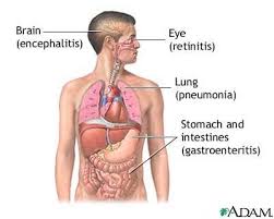 Cmv Cytomegalovirus Home Health Remedies Natural Home Remedies Natural Remedies