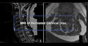 Bulging Disc in Neck: Causes, Signs, Treatment, and Recovery Guide