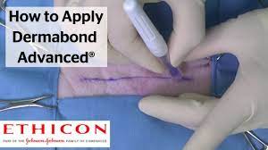 Be less worried about surgical glue as the issue. How To Apply Dermabond Advanced Skin Adhesive Ethicon Youtube