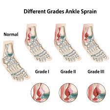 Find out what muscles are strained & what ligaments are sprained in your ankle. The Three Degrees Types Of Ankle Sprains