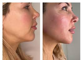 Plasma fibroblast works wonders