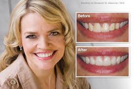 Many people do not know that veneers have the same color as teeth, and they reflect light the same way as the natural ones you have. Porcelain Veneers Your Smile Better Than Ever
