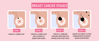 Image result for Breast Cancer Staging
