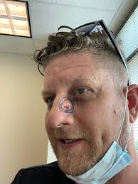 Basal cell carcinoma surgery recovery after 2 years