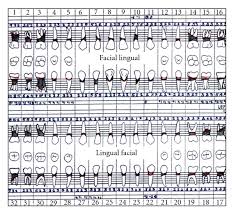 Periodontal Charting Showing Generalized Deep Pockets And