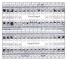 Periodontal Charting Showing Generalized Deep Pockets And