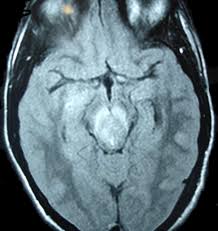 For a general discussion, and for links to other system specific manifestations, please refer to the article on coccidioidomycosis. Mri Features Of Japanese Encephalitis Bmj Case Reports