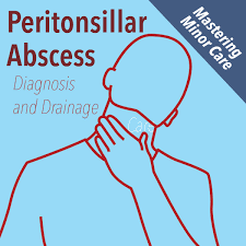 Image result for Peritonsillar Abscess