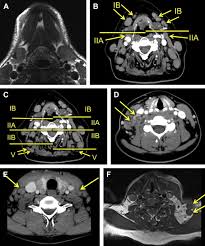 Lymph node biopsies from 37 patients, who were tested for toxoplasmosis by serologic and isolation studies, were examined. Imaging Of Head And Neck Lymph Nodes Radiologic Clinics