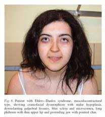 Ehlers-Danlos Syndrome and the Overlap with Orthostatic Intolerance  Presenter Disclosure Information EDS, JH, and Orthostatic In