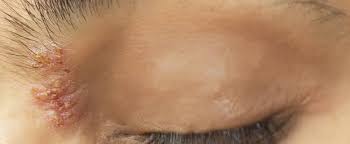 Zur unterstützung von innen her nimmt man. Inwiefern Kann Gurtelrose Im Gesicht Auftreten