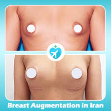 Recovery after breast augmentation varies based on a variety of factors. A Complete Guide To Breast Augmentation Recovery Ariamedtour