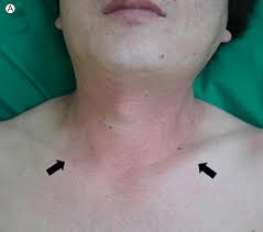 Bumps, lesions, scales, and blisters can all be classified as skin rashes. A V Sign On The Neck And Anterior Chest Arrows B Diffuse Download Scientific Diagram