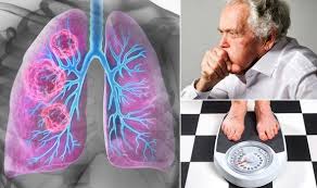 Learn about lung cancer early warning signs, symptoms and treatments. Lung Cancer Symptoms The 12 Most Common Warning Signs Of A Tumour Full List Express Co Uk