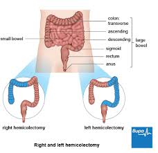 If you have an advanced cancer, the cancer may cause diarrhoea. Bowel Surgery Health Information Bupa Uk