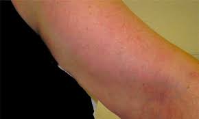 Die thrombose beschreibt die gerinnung des blutes mit bildung eines blutprofes. Thrombophlebitis Seien Sie Aufmerksam Venenthrombose