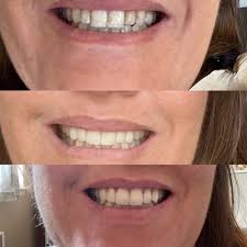 THE BEST 10 Teeth Whitening in BROOMFIELD, CO