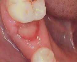 Food to eat after wisdom teeth removal. Wisdom Tooth Removal Recovery Period Natural Dentist Associates