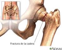 Reemplazo de la articulación de la cadera: MedlinePlus ...