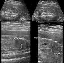 The Lying Down Adrenal Signis A Feature Seen Usually Associated With Renal Agenesis Or Renal Ectopia It Is An Important Antenatal Son Renal Adrenals Antenatal