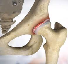 Image result for Hip Labral Tear